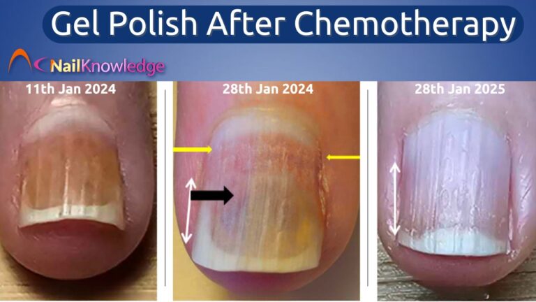 Gel Polish After Chemotherapy