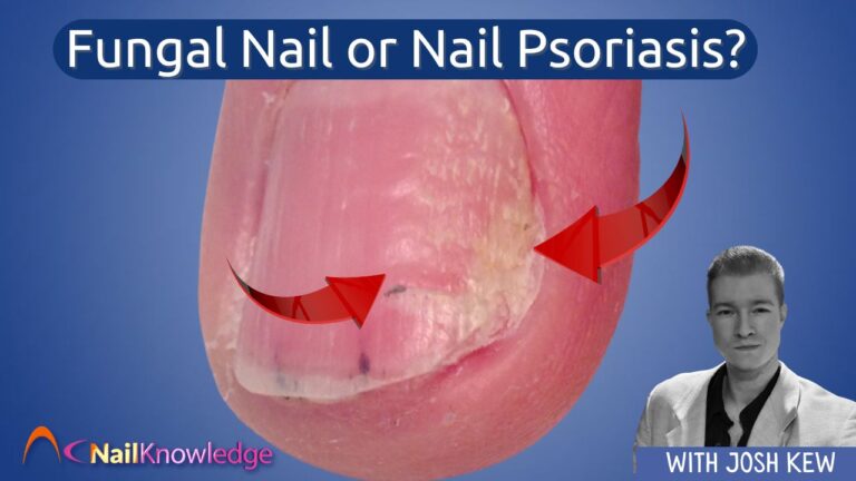 Fungal Nail or Nail Psoriasis
