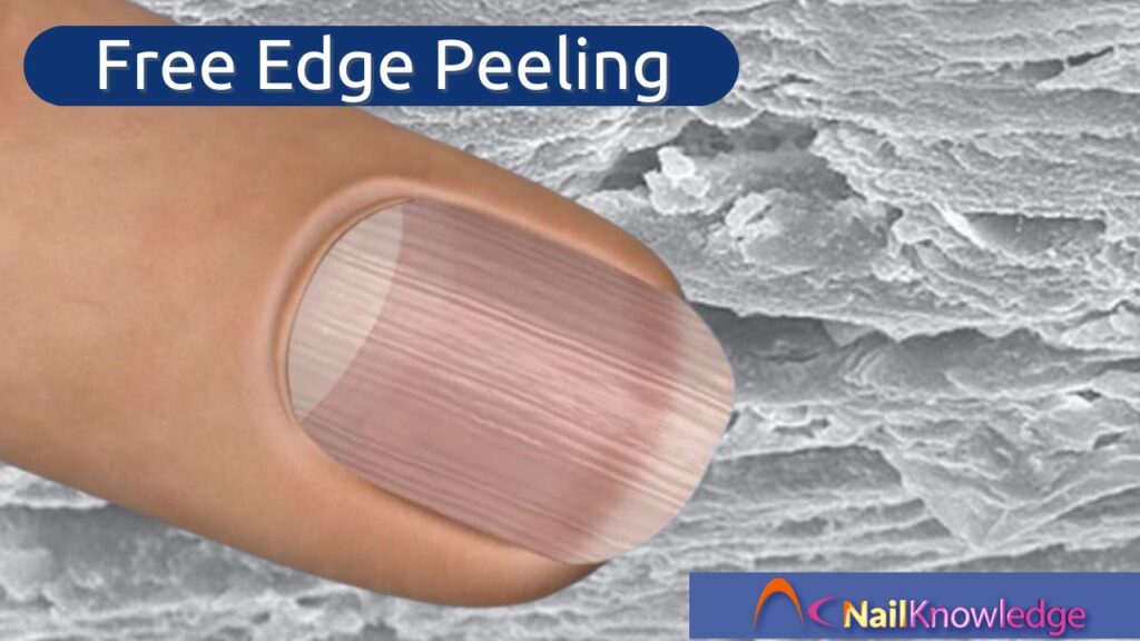 Peeling free edge of a natural nail plate