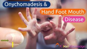 Onychomadesis & Hand Foot Mouth Disease