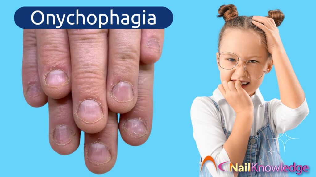 Onychophagia - Nail Biting