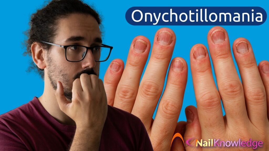 Onychotillomania